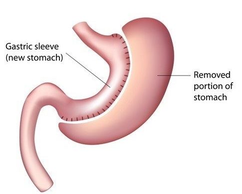 LAPAROSCOPIC SLEEVE GASTRECTOMY