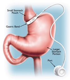 Gastric-Banding-dubai