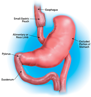 Gastric Bypass