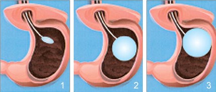 INTRAGASTRIC BALLOON