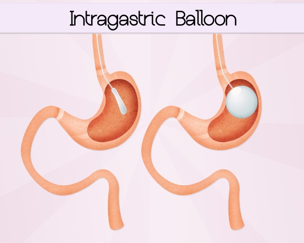 What Is The Average Weight Loss Following An Intragastric Balloon Procedure?